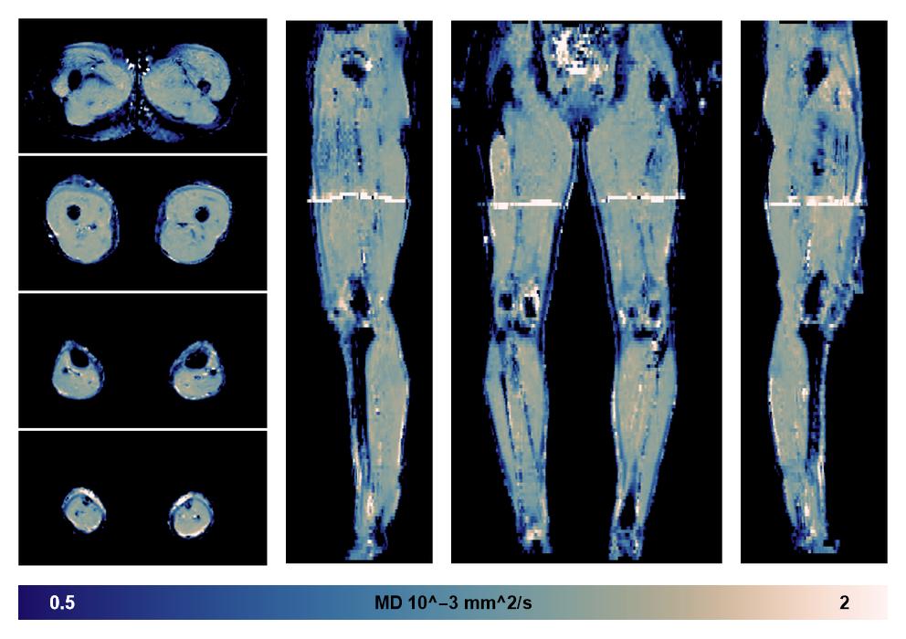 IVIM corrected whole leg muscle mean diffusivity obtained from diffusion tensor imaging.